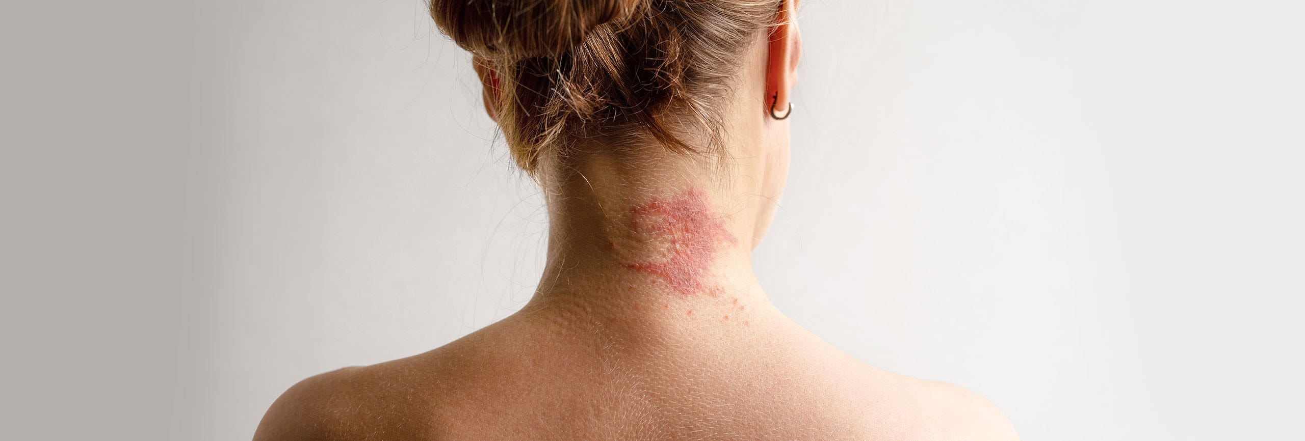 Dermatitis seborreica