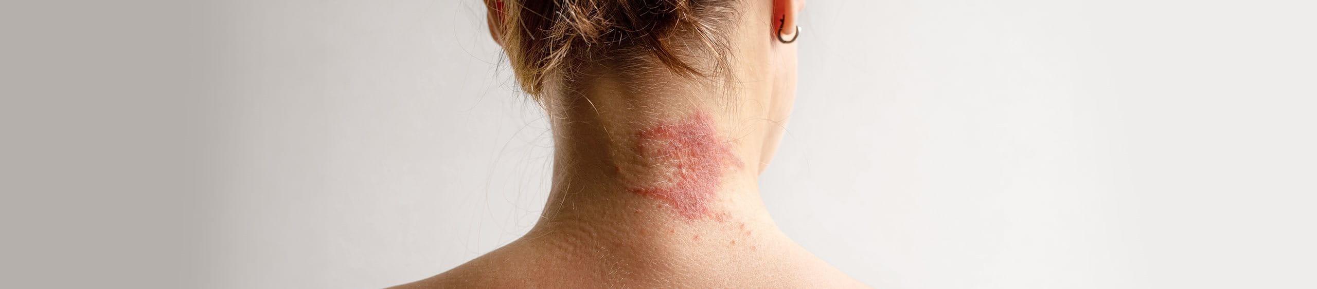 Dermatitis seborreica