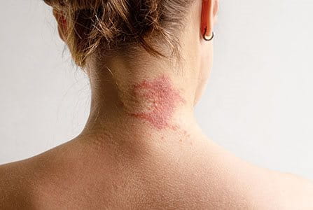 Dermatitis seborreica