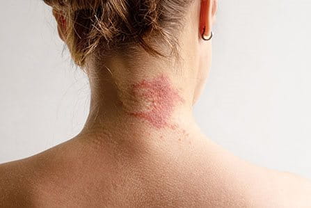 Dermatitis seborreica