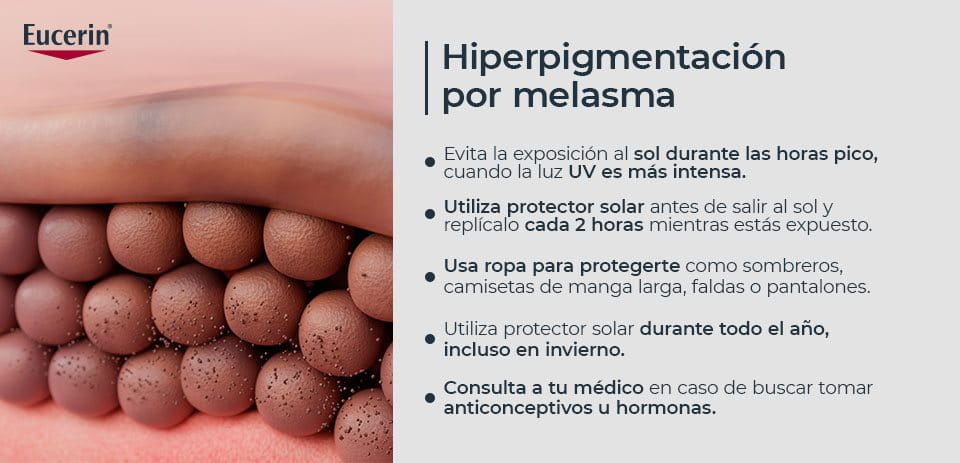 ¿Cómo prevenir la hiperpigmentación por melasma?