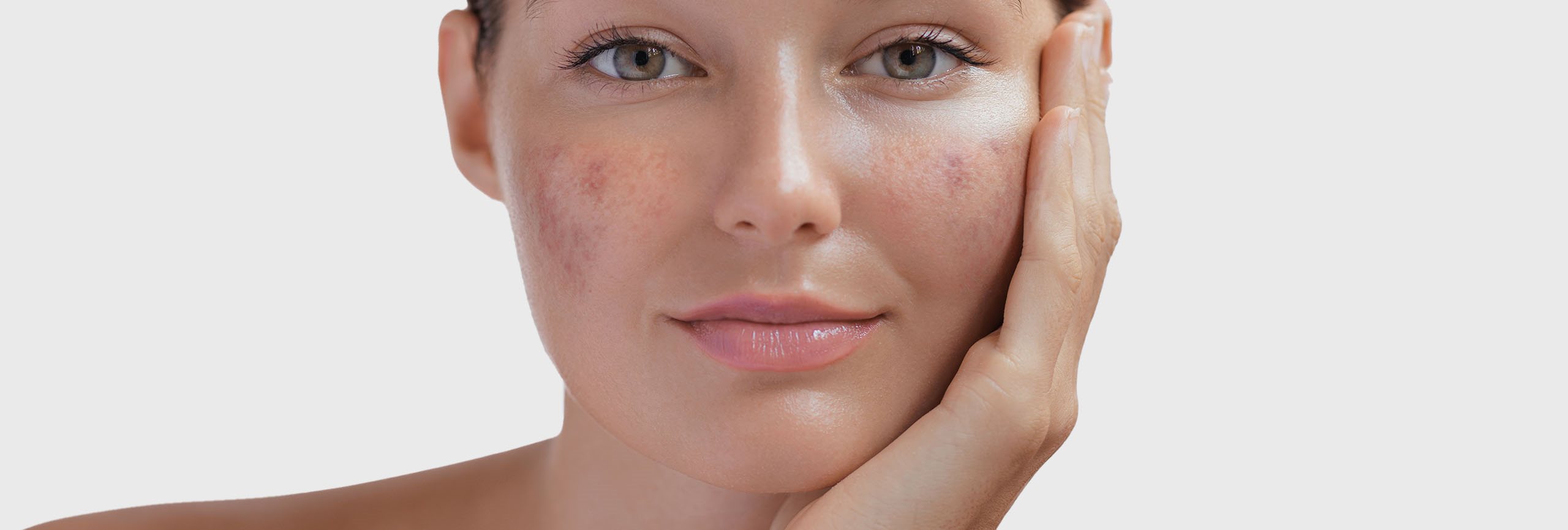 ¿Qué es el melasma?