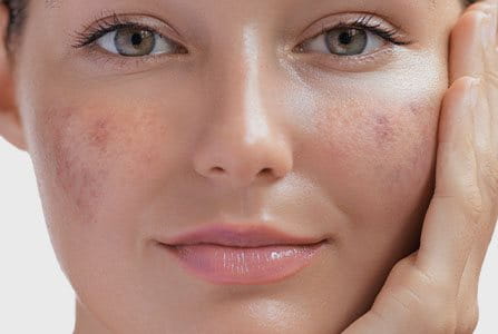 ¿Qué es el melasma?