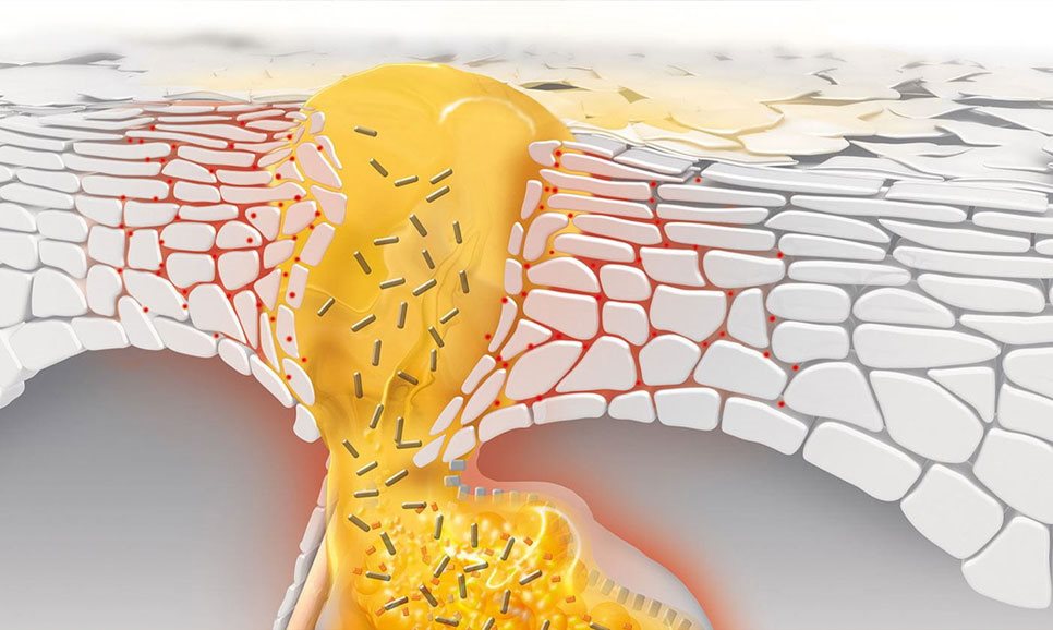 Kako nastaju bubuljice i kako se one razvijaju u akne?