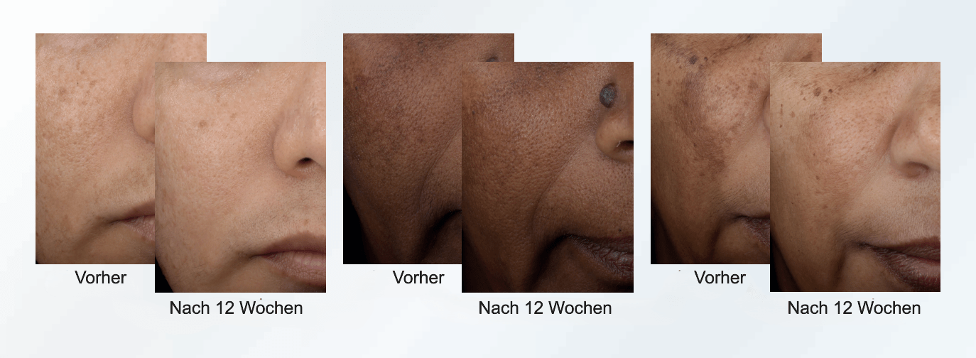 Drei Vorher-Nachher-Bilder von drei verschiedenen Frauen, auf denen die Veränderungen von Pigmentflecken jeweils nach zwölf Wochen abgebildet sind. Bei allen drei sind die Pigmentflecken nach zwölf Wochen sichtbar reduziert.