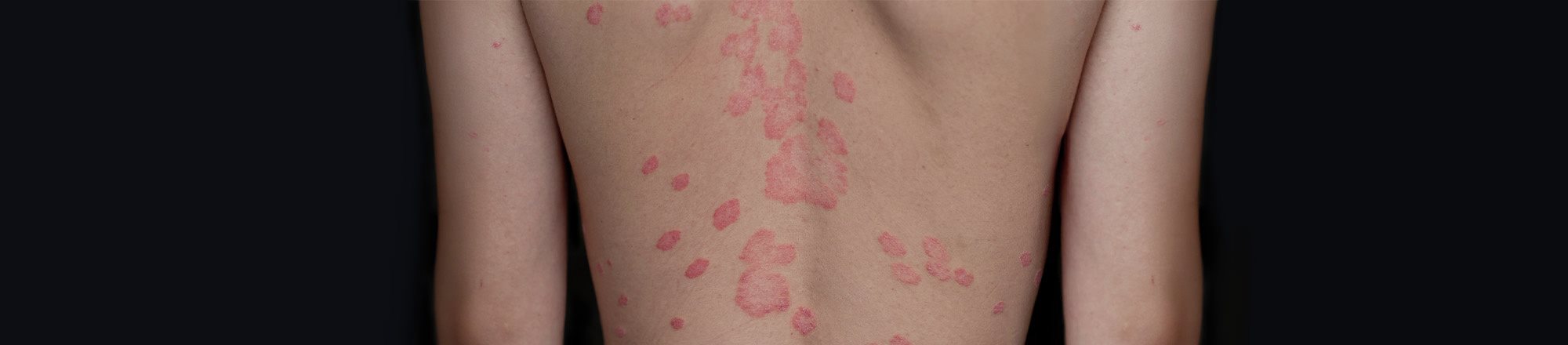 foto di ragazza con psoriasi