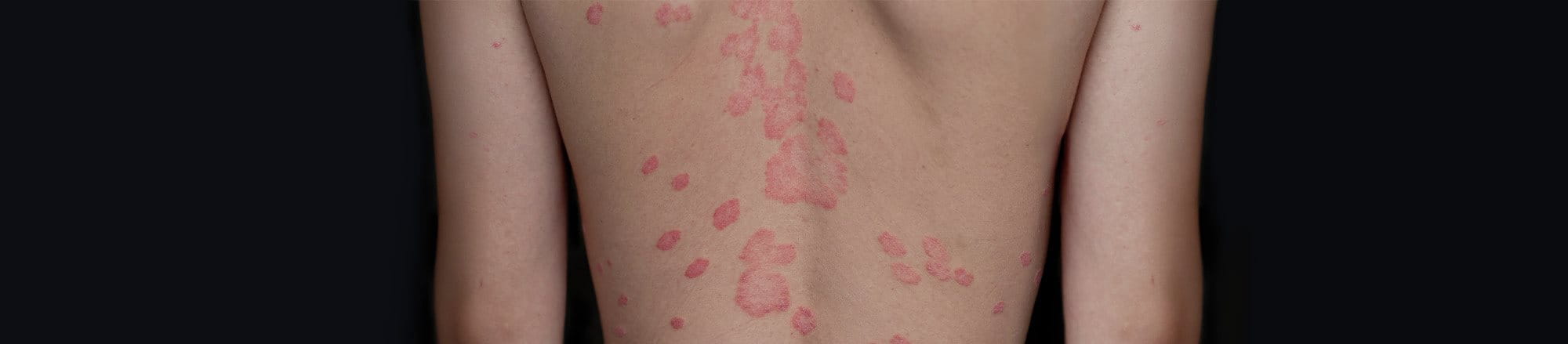 foto di ragazza con psoriasi
