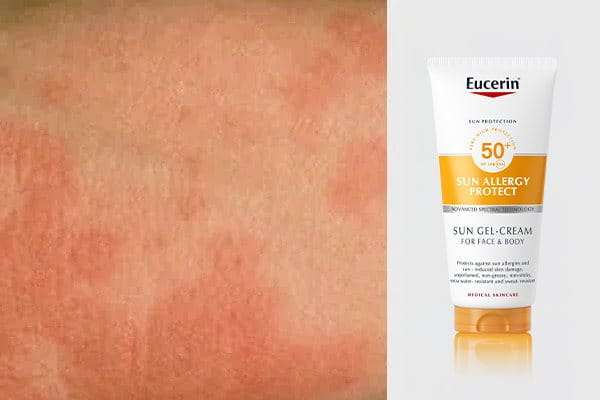 OBČUTLJIVA KOŽA IN KOŽA Z ALERGIJAMI NA SONCE