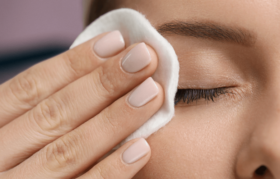 Close-up van gezicht met onzuiverheden; een vrouw verwijdert make-up met een watje.