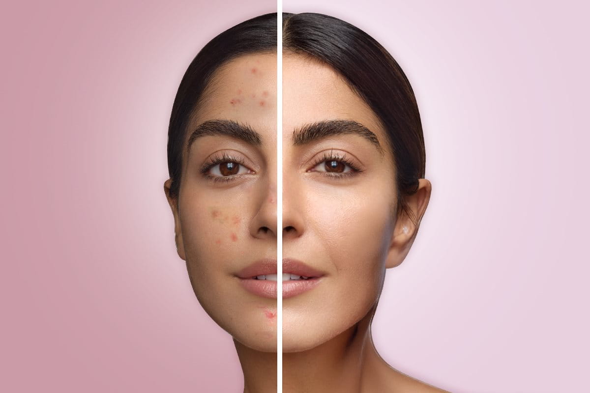 Before vs after acne treatment