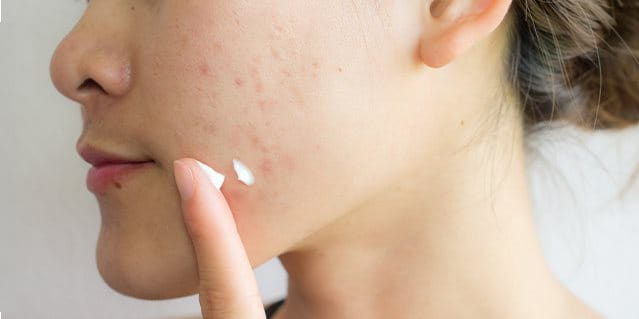 brufoli sulla guancia sinistra