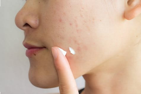 brufoli sulla guancia sinistra