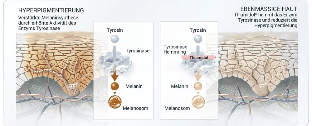 Grafische Darstellung der Tyrosinase. Auf dem linken Bild ist dargestellt, wie Hyperpigmentierung entsteht: Eine erhöhte Aktivität des Enzyms Tyrosinase führt zu einer verstärkten Melaninsynthese, was zur Bildung von Melanin und einer sichtbar dunkleren Pigmentierung der Haut führt. Auf dem rechten Bild ist die Wirkweise von Thiamidol dargestellt: Es hemmt das Enzym Tyrosinase, wodurch die Hyperpigmentierung reduziert wird.