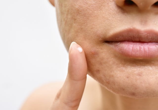Donna con segni di acne sulla pelle applica crema topica sul mento come trattamento