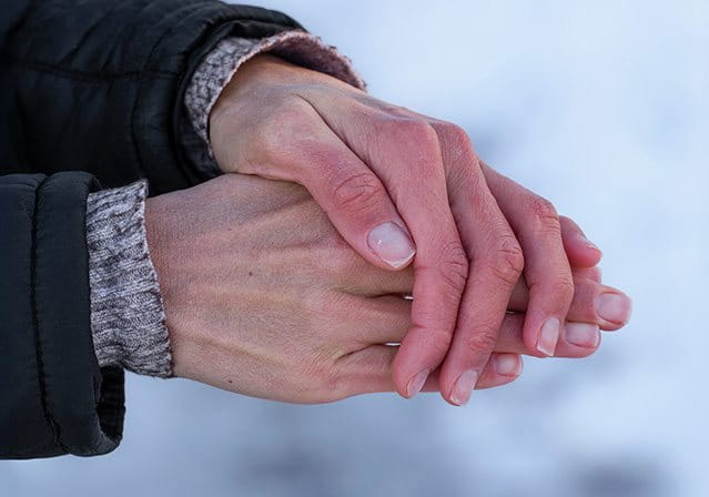 foto di mani con dermatite da freddo 