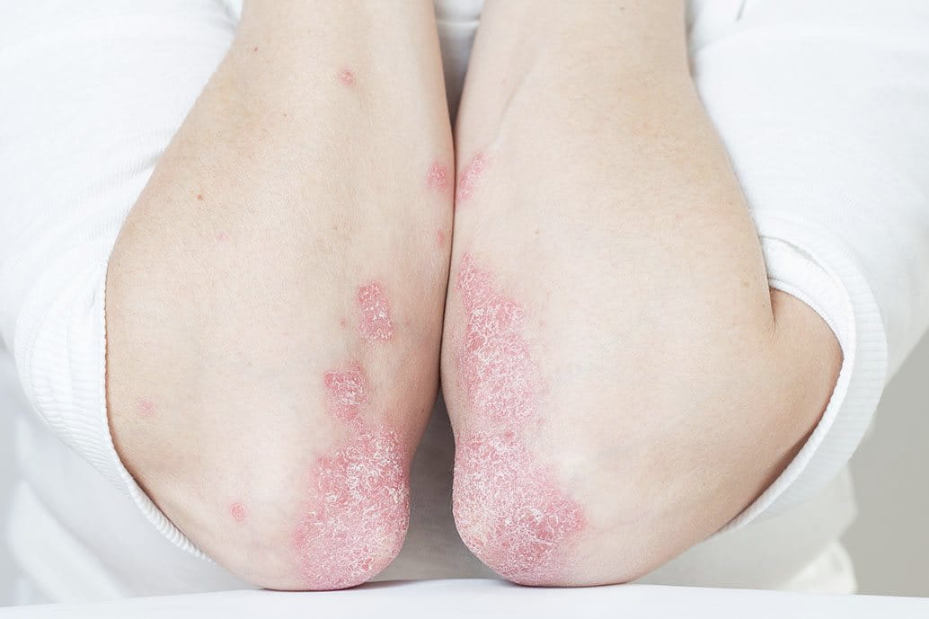 Dettaglio dei gomiti di una persona con psoriasi eritrodermica, evidenti lesioni arrossate e desquamazione cutanea.