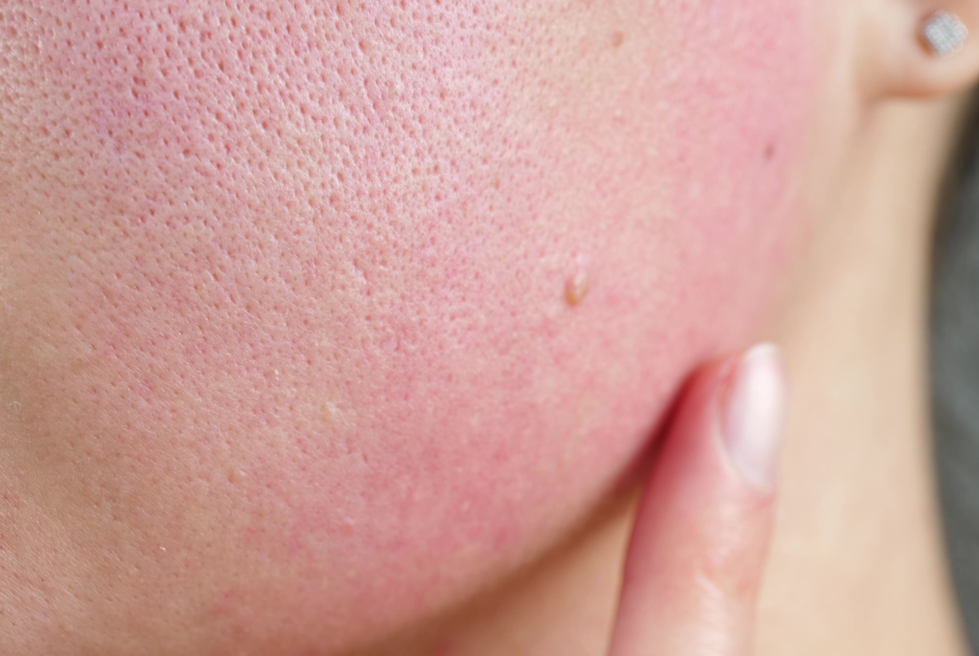 Nahaufnahme einer geröteten Haut im Gesicht, durch das Flush-Syndrom. Die Haut ist sichtbar irritiert und zeigt erweiterte Poren sowie eine feuchte Oberfläche, durch die Hitzewallungen.