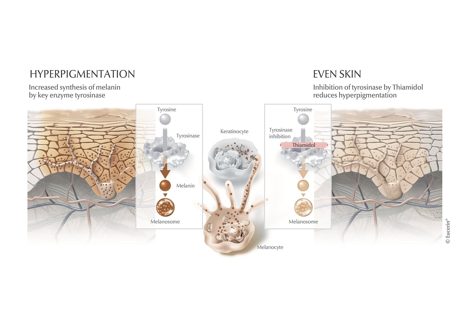 A graphic illustration depicting hyperpigmentation and how Thiamidol works to achieve a more even skin tone.