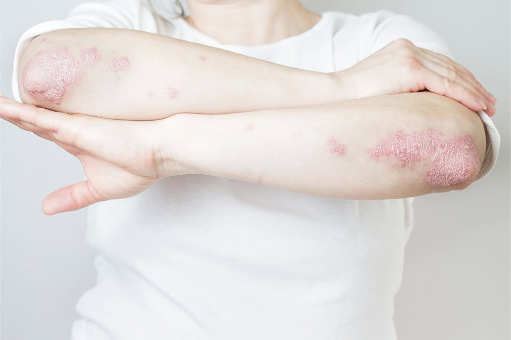 psoriasi su mani e avambracci