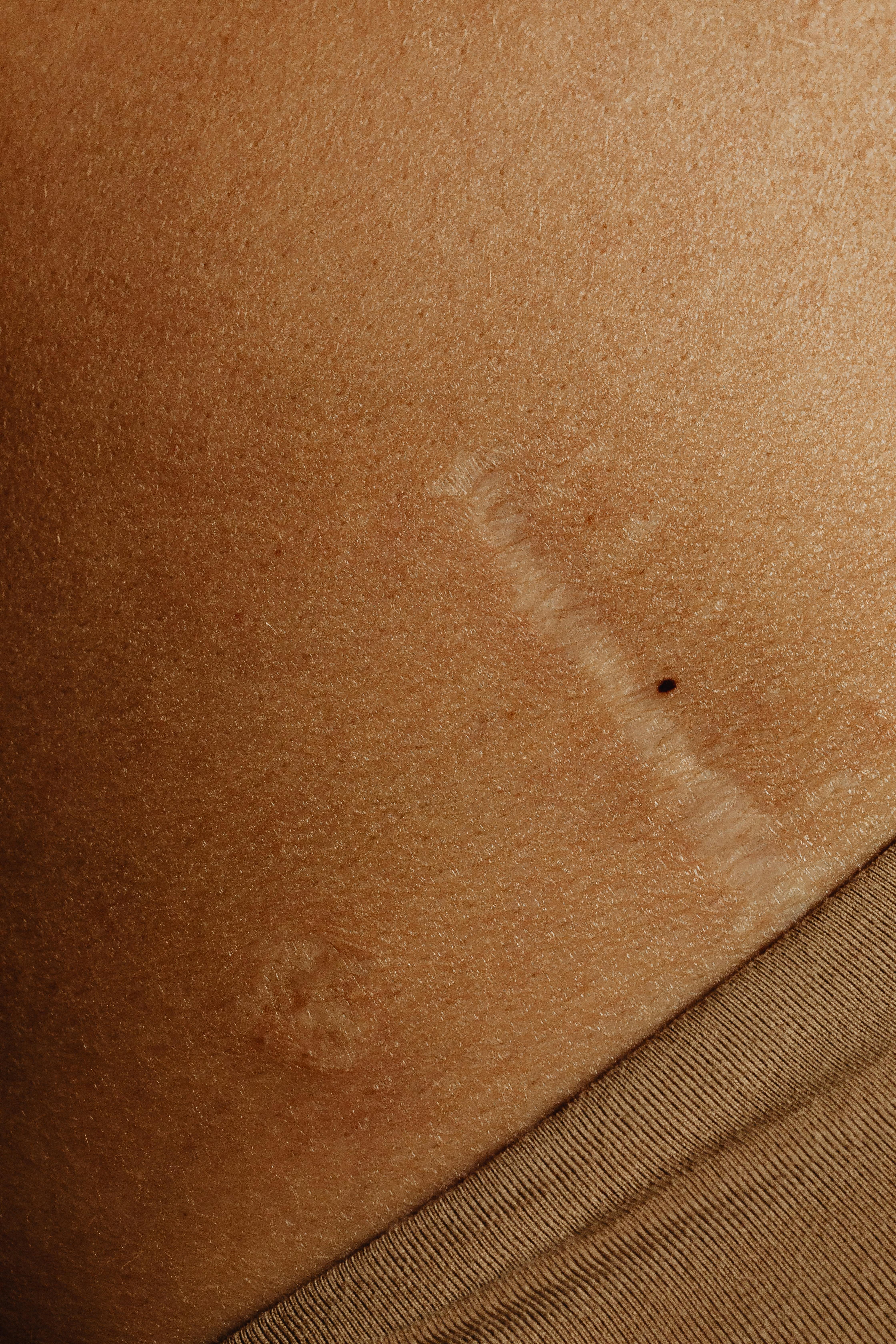 Hypertrophe Narbe, die durch eine leichte Wölbung des Haut- und Narbengewebes erkennbar ist.