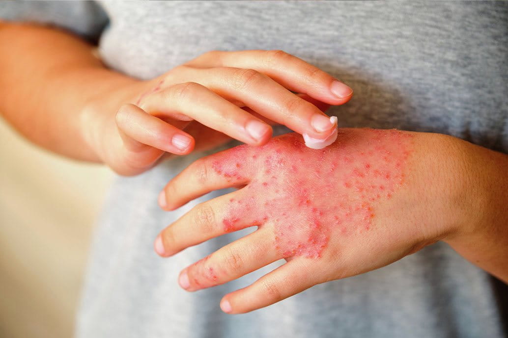 Persona che applica una crema sulle mani affette da psoriasi a placche