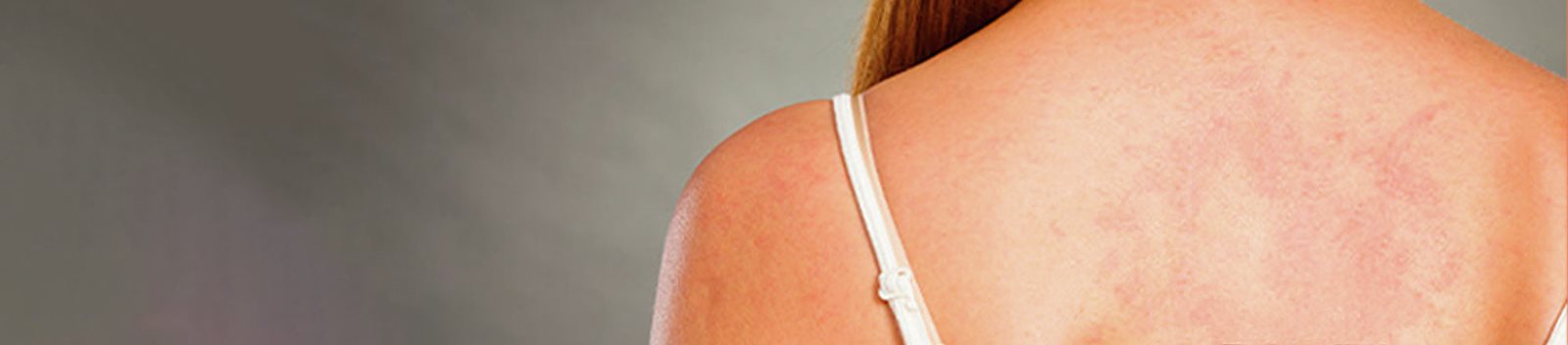 Pelle con eruzione cutanea di pitiriasi rosea di Gibert su schiena