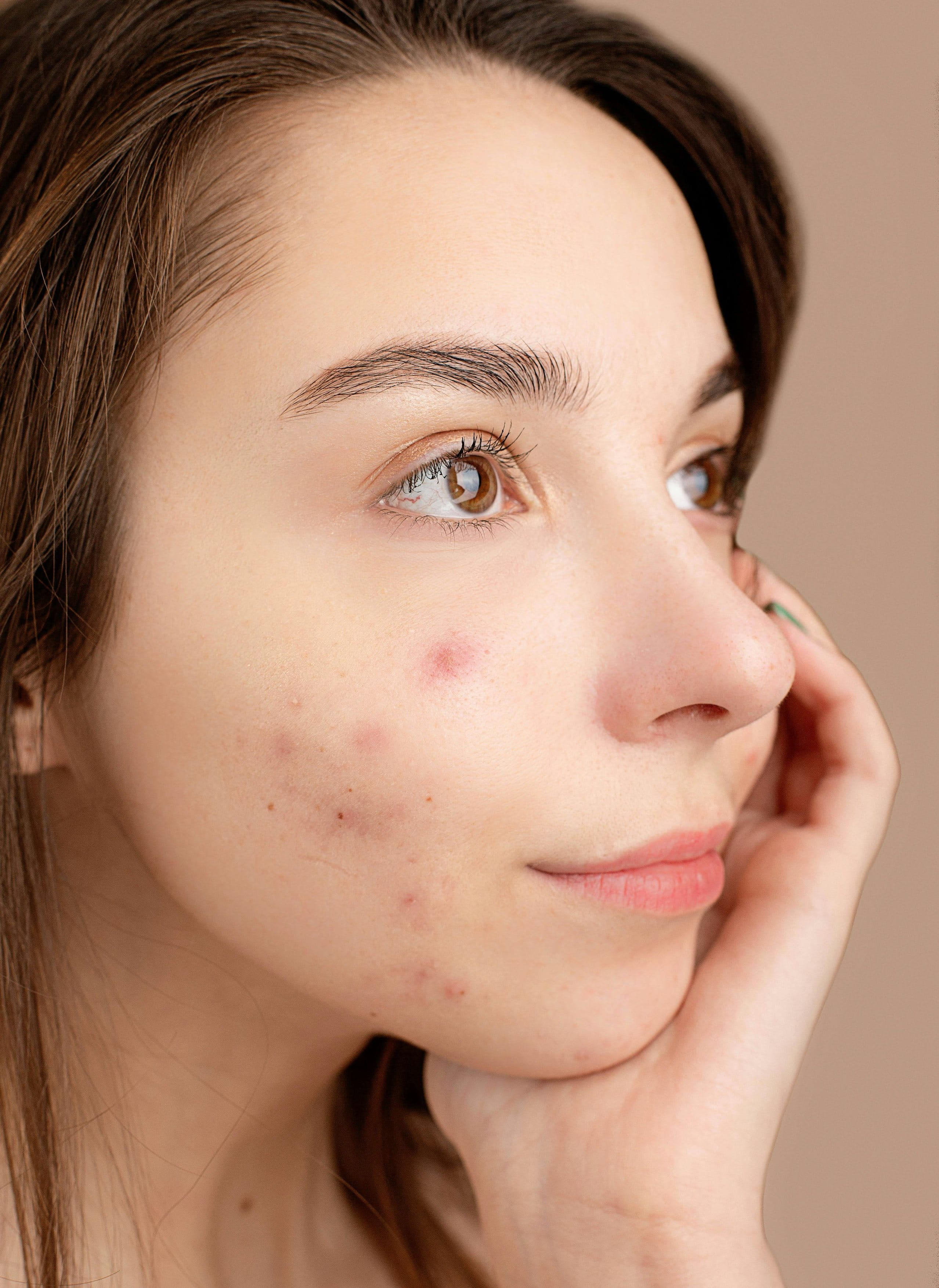 a close-up image of skin purging