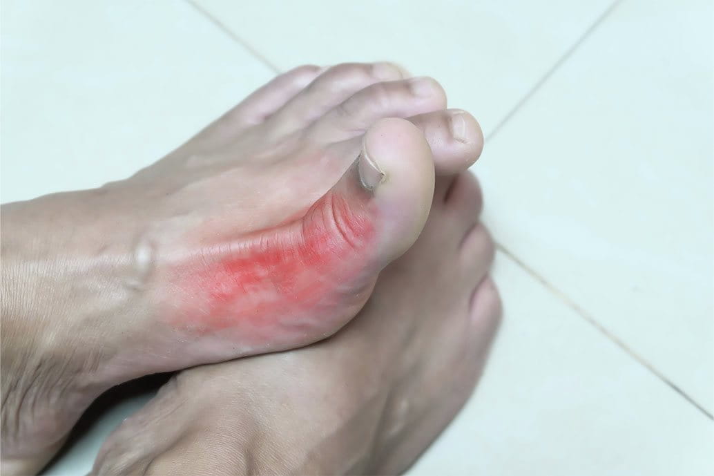 foto di piede di donna con arrossamento da intertrigine