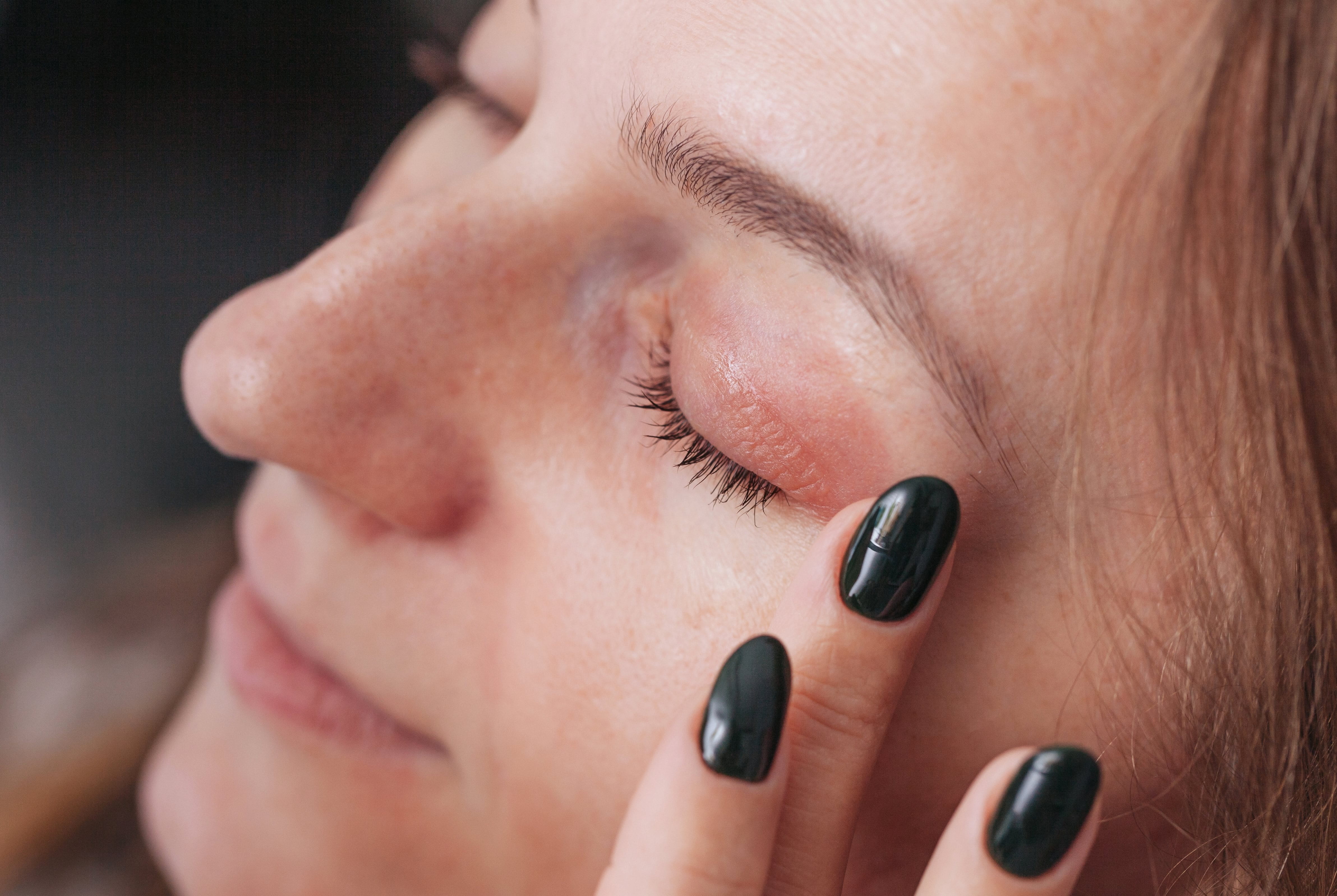 Frau fässt sich an das gerötete Augenlid.