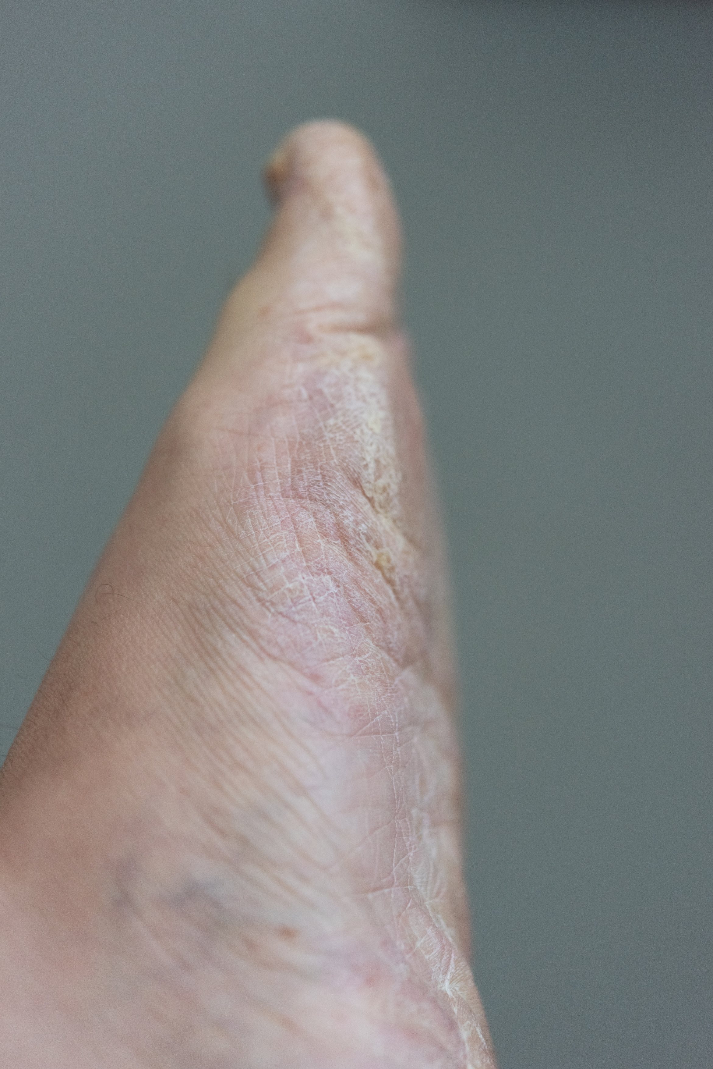 Nahaufnahme trockener, rissiger Haut an der Fußsohle – möglicher Hinweis auf Fußpilz oder Hauterkrankung.