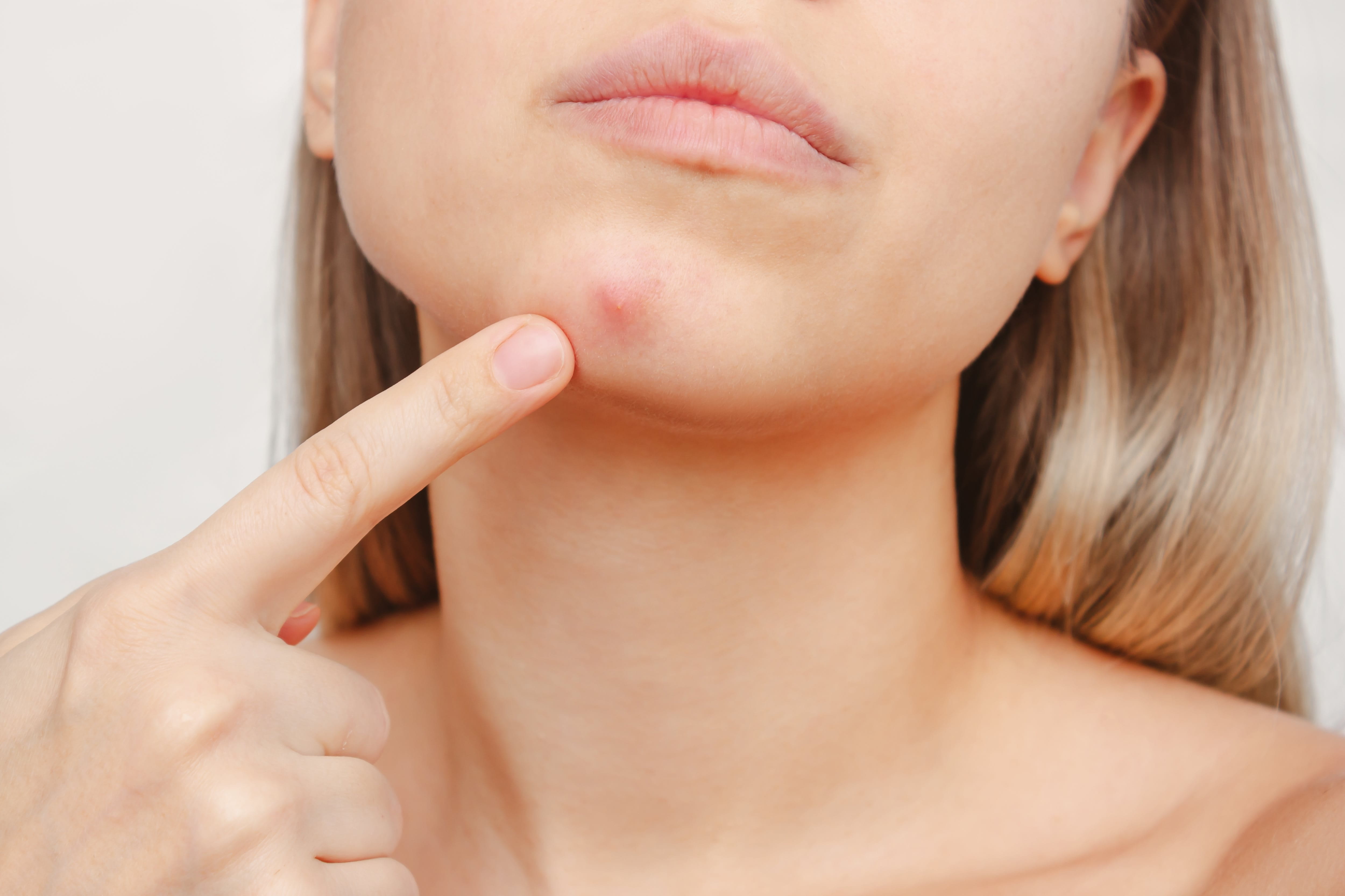 Frau zeigt mit dem Finger auf einen einzelnen entzündeten Pickel am Kinn.