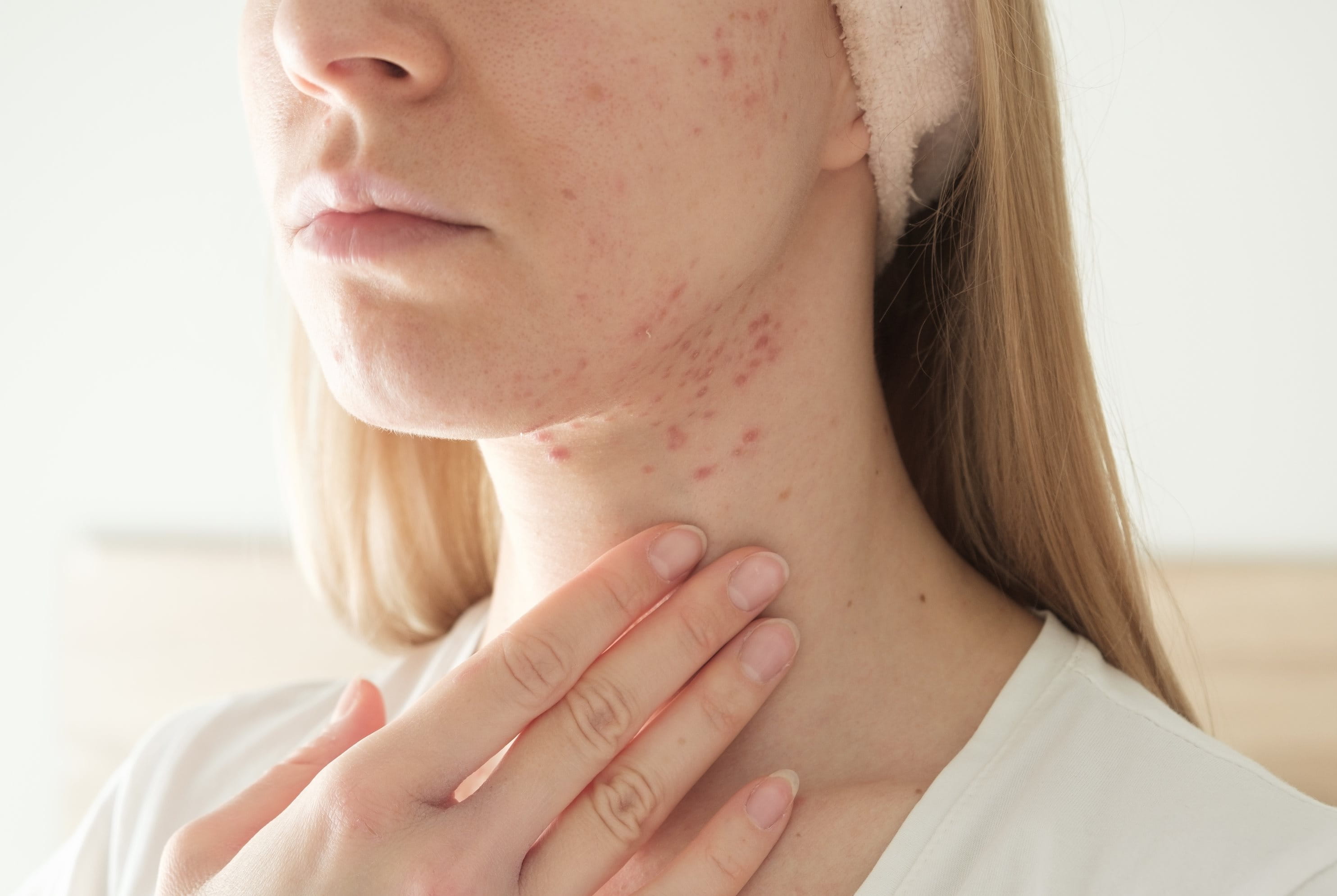Nahaufnahme einer Frau, die sich vorsichtig an ihre Pickel am Hals fasst.