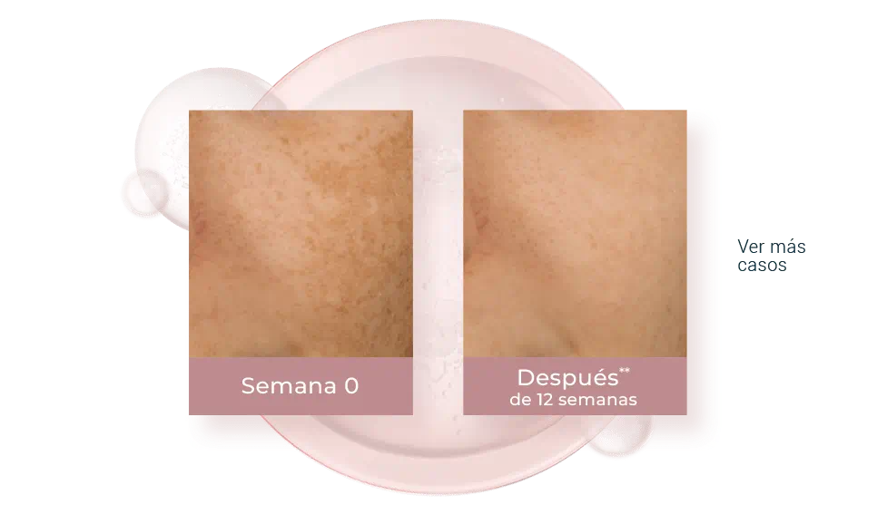 Resultados del uso de Dual Serum en 12 semanas