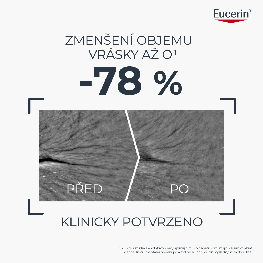 Zobrazení stavu před a po uskutečnění klinické studie, ve které Eucerin Hyaluron-Filler + Longevity Epigenetic Omlazující sérum přineslo až -78% redukci objemu vrásek