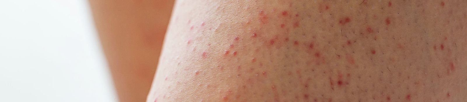 Gambe con follicolite post ceretta con puntini rossi e irritazione cutanea diffusa.