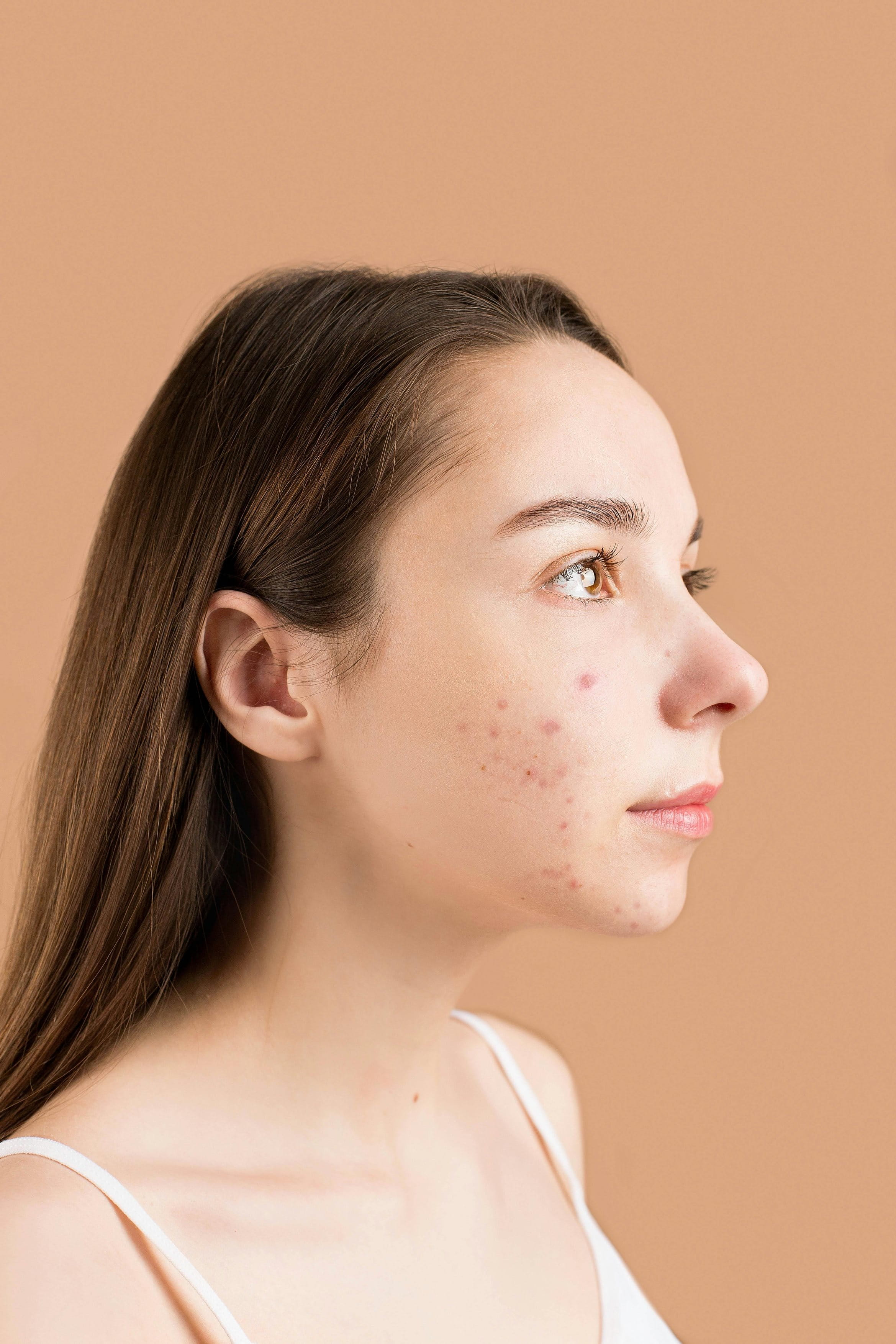 A woman with blemishes and closed comedones on face