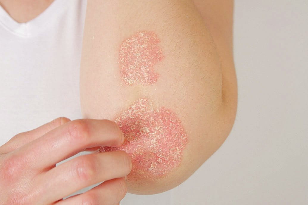 Braccio con lesione arrossata da psoriasi