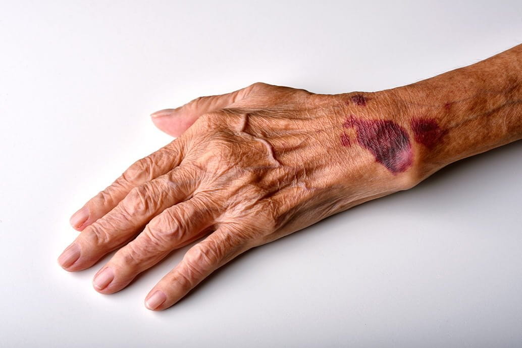 braccio di persona con dermatoporosi