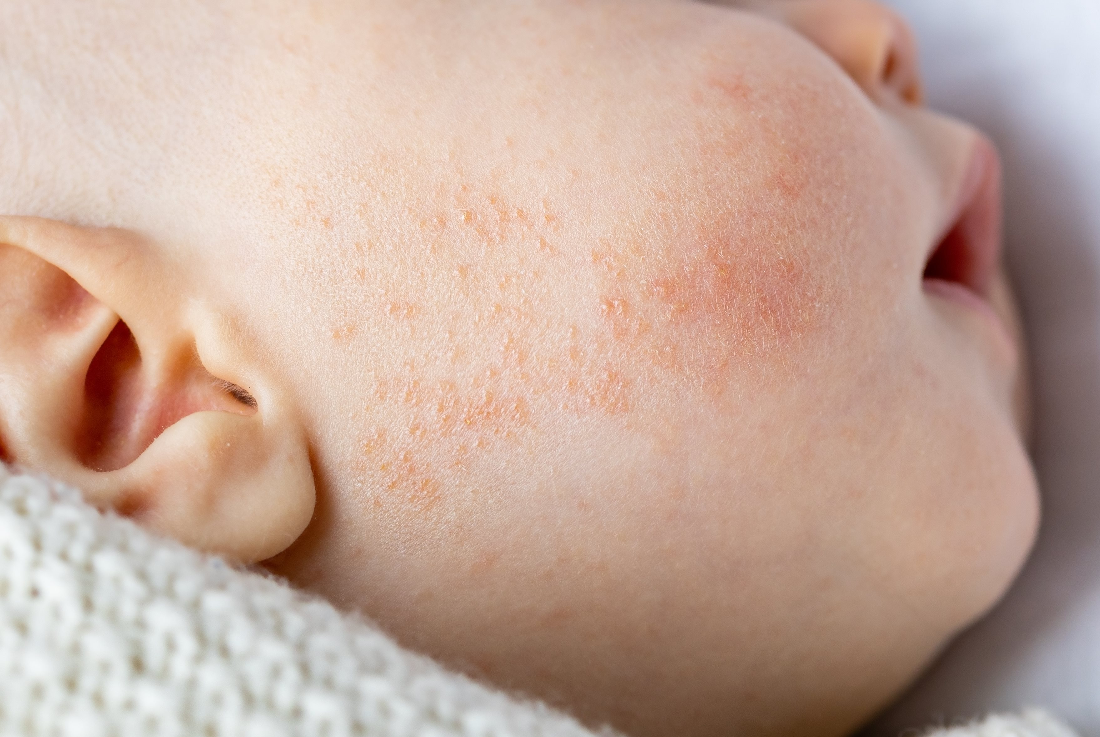 Baby mit Neugeborenenakne auf den Wangen.