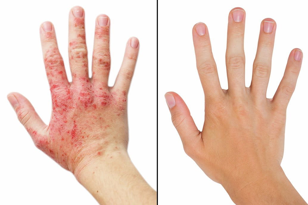 Confronto prima e dopo il trattamento della psoriasi a placche su un braccio 