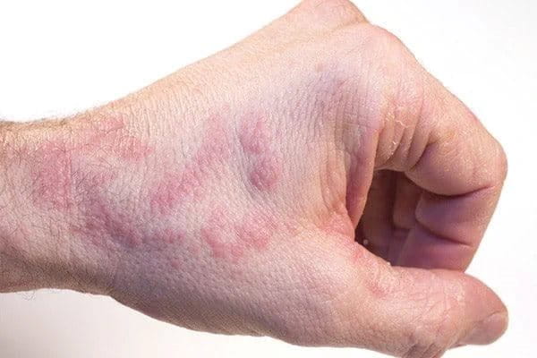 A picture of eczema on the back of the hand