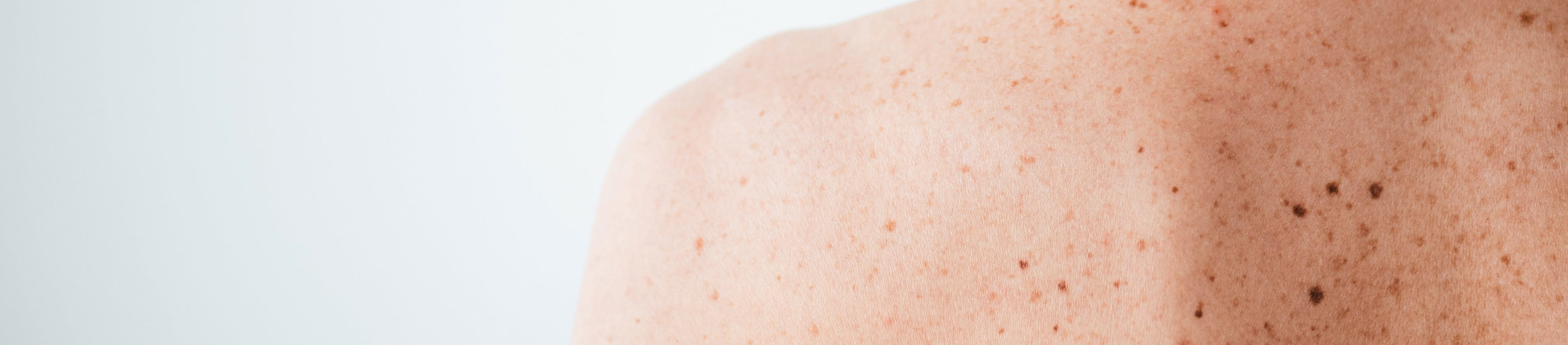 Schulter und oberer Rückenteil einer Frau, auf dem Pigmentflecken und Muttermale zu sehen sind.