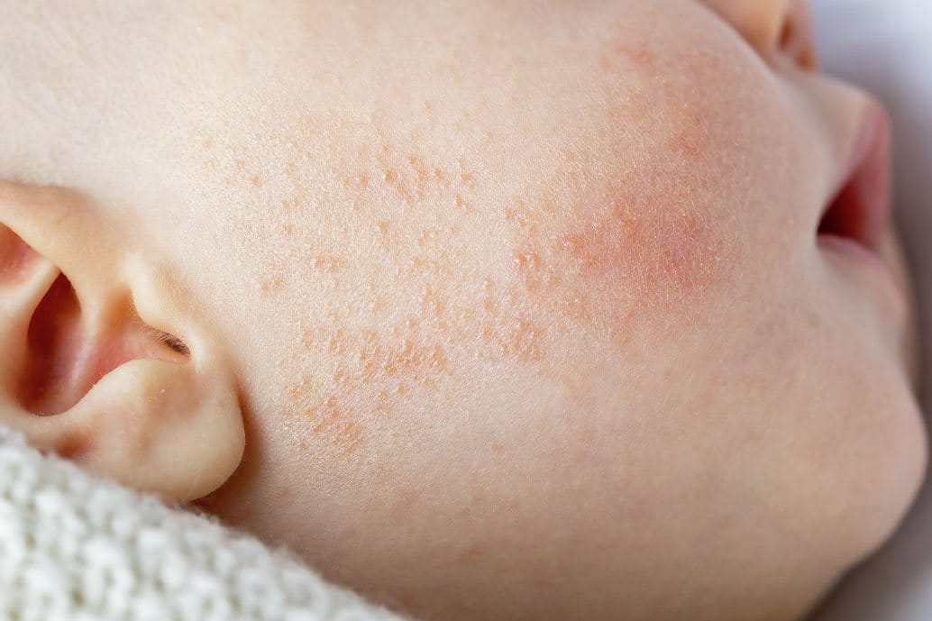 Guancia di un neonato con acne neonatale.