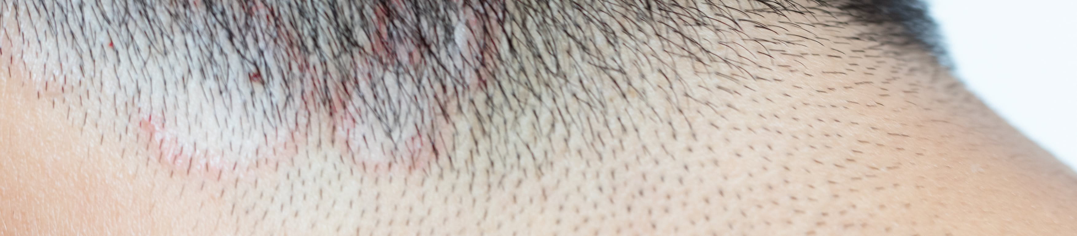 Nahaufnahme vom Haaransatz eines Mannes mit schwarzem Haar und deutlich sichtbarer Tinea capitis.