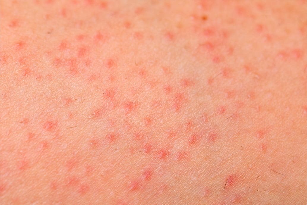 pelle con follicolite