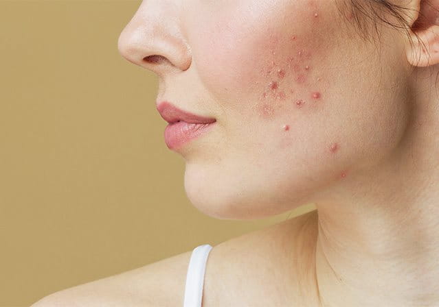 foto di ragazza con pelle del viso acneica