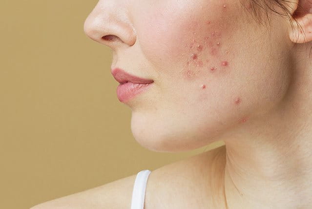 foto di ragazza con pelle del viso acneica