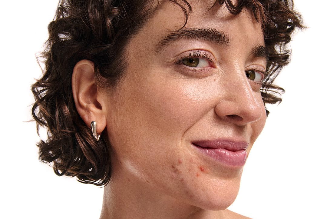 como-afectan-las-hormonas-a-la-piel-acne