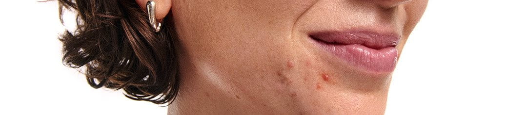 como-afectan-las-hormonas-a-la-piel-acne