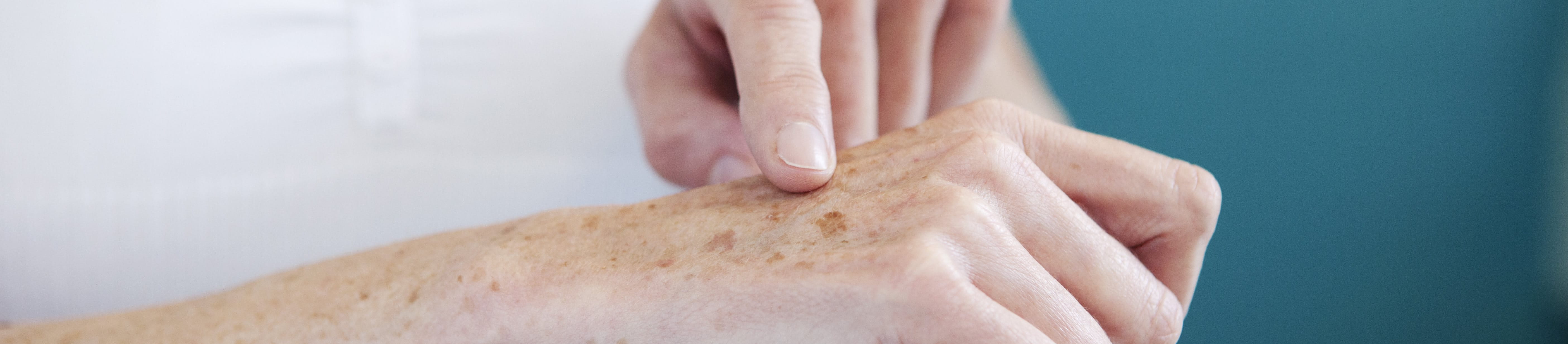 Nahaufnahme einer Hand mit sichtbaren Altersflecken.